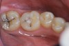 Figure 4  Caries present in tooth No. 18 and sealant of tooth No. 19 with suspected caries along margins.