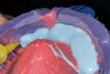 Figure 9  Silicone die material injected into impression.