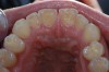 Figure 2  The erosion on the palatal surfaces of the upper incisors was more advanced than on the bicuspids, which show earlier signs of erosion. The cause could not be attrition, so the most likely explanation was erosion. The typical hollowed-out occlusal surfaces on the teeth are indicative of erosion.