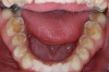 Figure 3  Left untreated and without preventive advice, erosion will continue to develop. In this case, the erosion had started to attack most tooth surfaces, making sensitivity a common finding.