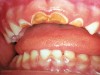 Figure 4  Classic early childhood caries demonstrating massive destruction of maxillary anterior teeth.