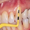 Figure 1  Manual probes with replaceable color  tips make it easy for the patient to see the  recorded pocket depth.