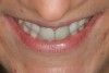 Figure 16  The tip-down smile photo of case two. The anteriorly positioned incisal edges of teeth Nos. 8 and 9 can be clearly seen.