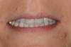 Figure 19   The "e" position photo in case two. The incisal edges are in the 75% to 80% position.