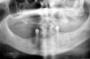 Figure 18  Panoramic radiograph showing decreased bone density.