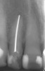 Figure 2  A radiograph finds no pulp chamber in the slightly dark central incisor and a silver point on the darkest lateral incisor. A titrated approach to bleaching was needed using individual tooth treatments.