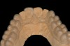 Figure 8  The single-tooth bleaching tray extended further onto the palate than the traditional tray to preserve the tray integrity when the adjacent teeth molds were removed from the tray. The tray edges are hidden behind rugae and go onto the tissue in all areas.