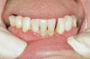 Figure 10  Patient who takes oral bisphosphonates and suffers from periodontal disease.