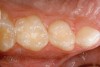 Figure 5  Preoperative photograph of tooth A.