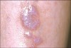 Figure 2  Skin lesion from lichen planus.