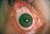 Figure 8  Symblepharon of the eye caused by pemphigoid.