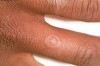 Figure 18  Classic target lesion of erythema multiforme.
