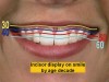 Figure 6  The gumminess of the smile decreases with age. This illustration demonstrates the changes by the decade.