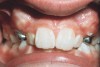 Figure 7  This patient had severe crowding with completely blocked-out canines. Premolar extraction appears to be inevitable.