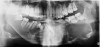 Figure 3  Panoramic radiograph shows a multilocular radiolucency extending from the left second molar to the right first molar.