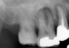 Figure 5  Usually, teeth with large periapical abscesses will test nonvital.