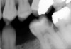 Figure 6A Bitewing radiograph. Deep caries evident radiographically for the mandibular first molar.