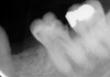 Figure 6B Periapical radiograph. Deep caries evident radiographically for the mandibular first molar.