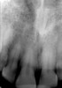 Figure 7A Deep caries evident on the radiograph for tooth No. 9.