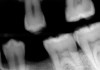 Figure 8A Evidence of deep caries on bitewing radiograph for tooth No. 14.