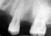 Figure 8B No evidence of periapical pathology for tooth No. 14.