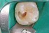 Figure 8D Removal of caries reveals necrotic pulp (no frank bleeding when the pulp was exposed.