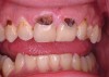 Figure 9A Deep Class V caries (pulpal vitality test: no response).