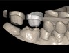 Figure 10  The digital impression data is input to the program for design and milling of the zirconia coping and digital veneer.