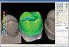 Figure 12  Reduction of the full-contour design to create the zirconia substructure with customized support for the CAD/CAM veneer layer.
