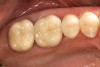 Figure 17  Occlusal view of cemented crowns for teeth Nos. 2 and 3.