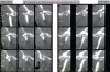 Figure 9b  Figure 9 An example of orthodontic and orthognathic surgery being performed without adequate goals. B) Tomographic evidence of degenerative joint disease and condyles positioned distal to the center of the fossa.
