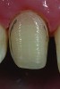 Fig 8. Photograph of the Class II veneer preparation demonstrating dentin exposure of 5% to 10%, less than the 20% maximum.
