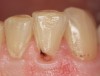 Figure 1  A Class V carious lesion on a lateral incisor.