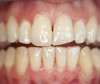 Figure 4  Teeth with multiple surface and structural defects required improving the smile design following orthodontics.