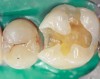 Figure 15  Tooth preparation after caries removal and enamel finishing.