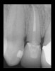 Figure 2  EVALUATION PARAMETERS  The location of the fracture relative to the alveolar crest makes this tooth a more challenging decision on whether to restore or extract.