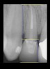 Figure 7  CLINICAL GUIDELINES  There are two methods for decisions based on crown-to-root ratio. One is the classical 1:1. The second, for maxillary anterior teeth, is 12 mm to 13 mm of tooth with 8 mm to 9 mm of root in bone and 4 mm coronal to the bone.