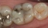 Figure  16  CLINICAL CASE  Occlusal view of tooth No. 30. Note the defective 3-surface filling with a portion of the distal‚Äìbuccal cusp missing and fracture lines on the lingual and buccal surfaces.