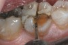 Figure 18  The mesial‚Äìbuccal cusp was removed with a horizontal cut that connected the mesial and buccal depth cuts.