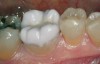 Figure 24   The milled lithium-disilicate all-ceramic restoration was tried in for fit and occlusal verification. Surface stains were then applied.