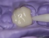 Figure  3  After dispensing a pea-sized amount on a mixing pad or 2X2 the fast-setting bis-acryl is injected into the matrix and re-seated over the final preparation.