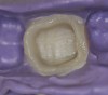 Figure  5  The interior and margins of the temporary created for this clinical case.