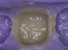 Figure  6  A temporary from another patient demonstrating the small amount of gingival flash that is routinely created with this technique.