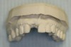 Figure  13   A tooth from an extra denture set that fits the space can be molded into position by using red rope wax.