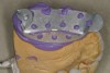 Figure  19  The mock-up is impressed,removed, loaded with bis-acryl, and re-inserted over the prepared teeth to create a provisional that needs little contouring and finishing.