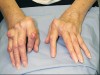 Figure 2  Erosions and deformity of hands.