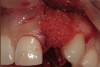 Figure 4   Extraction socket and ridge defect augmented with particulate freeze-dried bone allograft (FDBA) saturated with rhPDGF.