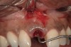 Figure 10  Submarginal flap elevation reveals apical concavity and associated fenestration defect.