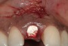 Figure 11  Extraction site following grafting, flap suturing, and adaptation and fixation of resorbable collagen membrane.