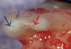 Figure 6  High-magnification view of mesio–buccal (blue arrow) and mesio–palatal (red arrow) roots. Small blue arrow marks another foramen emanating from the MB system.